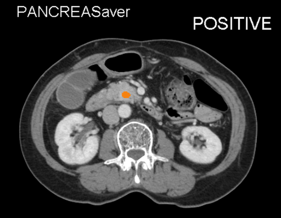 CT with AI annotation